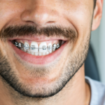 découvrez tout ce qu'il faut savoir sur l'appareil dentaire moustache, avec des astuces indispensables pour bien l'utiliser et en prendre soin au quotidien.