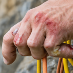 découvrez tout sur la ténosynovite du doigt chez les grimpeurs : causes, symptômes et traitements pour prévenir et soulager cette inflammation ligamentaire.